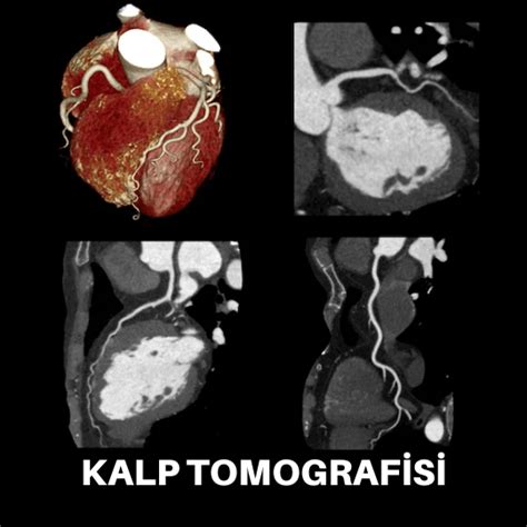 ilaçlı kalp tomografisi
